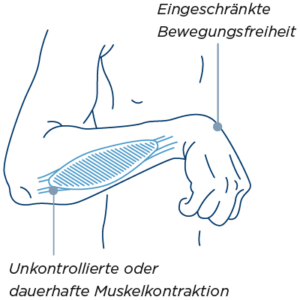 Spastik im Arm, eingeschränkte Bewegungsfreiheit durch unkontrollierte Muskelkontraktion.