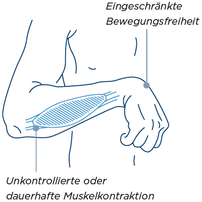 Spastik im Handgelenk