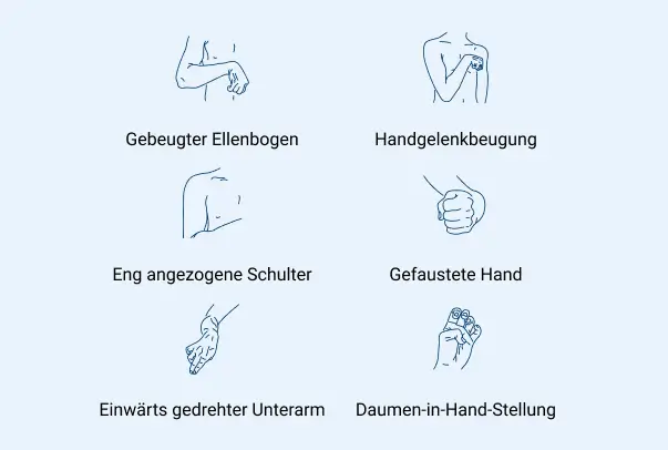 Illustrationen: spastische Fehlhaltungen von Arm & Hand: z.B. gebeugter Ellenbogen, Handgelenkbeugung, Fauststellung