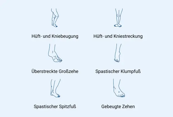 Illustrationen zum Spastik-Beinmuster: z.B. Hüft-Kniebeugung, Großzehenstreckung, Spitz- und Klumpfußvarianten.